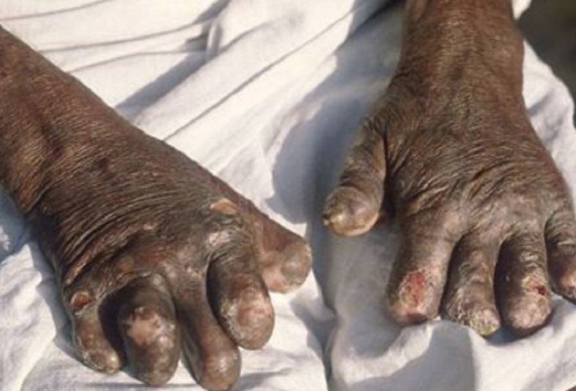 जाजरकोटमा १८ जना कुष्ठरोगी उपचाररत