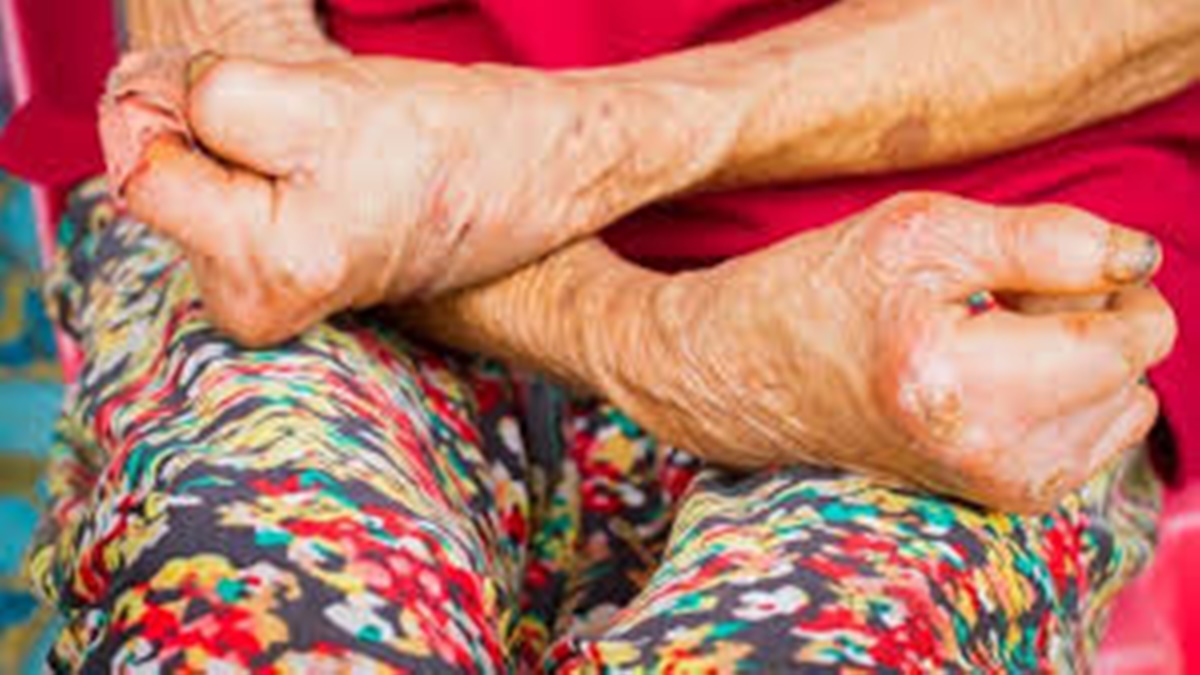 झापामा कुष्ठरोगको डरलाग्दो अवस्था : ६ महिनामै भेटिए ५५ नयाँ बिरामी