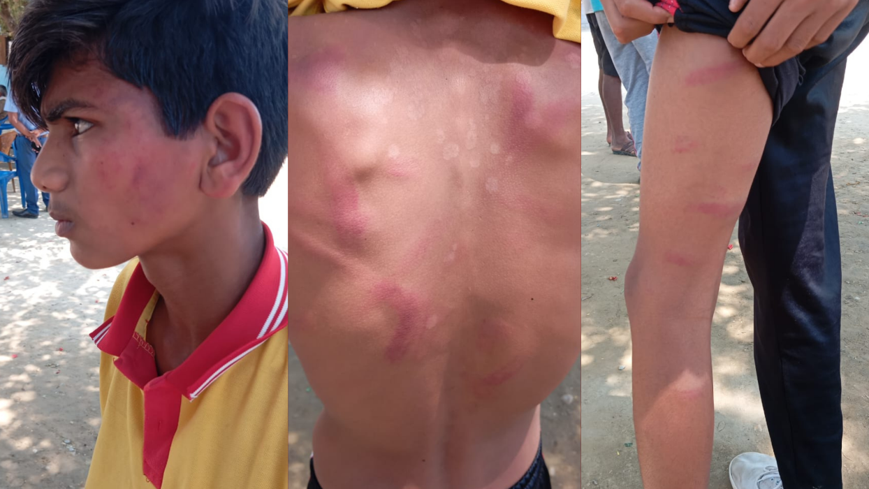 शिक्षकको कुटाइबाट १३ वर्षिय विद्यार्थी अविनास अस्पताल भर्ना