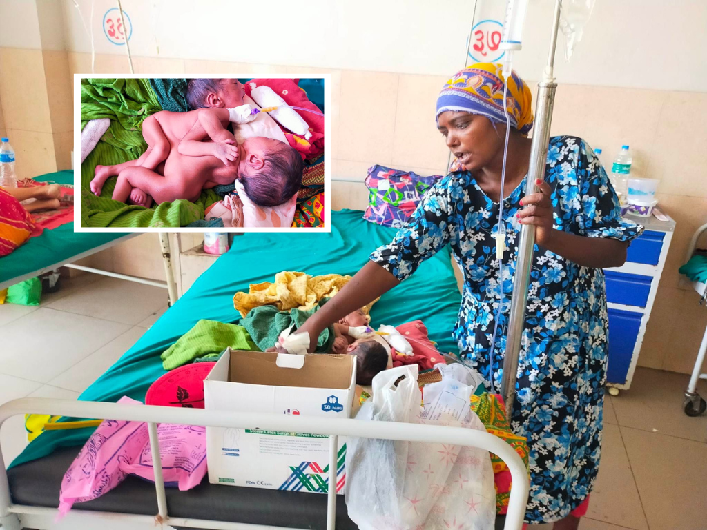 कोशी अस्पतालमा शरीर जोडिएका जुम्ल्याहाको जन्म