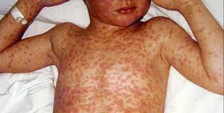 बिर्तामोडमा ५ वर्षीया बालिकामा दादुराको संक्रमण