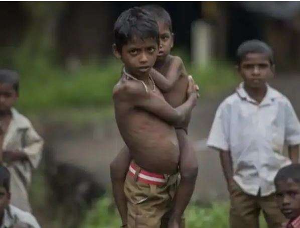 युएसएड बन्द हुँदा १ करोड ४० लाख बालबालिका भोकमरीमा पर्ने
